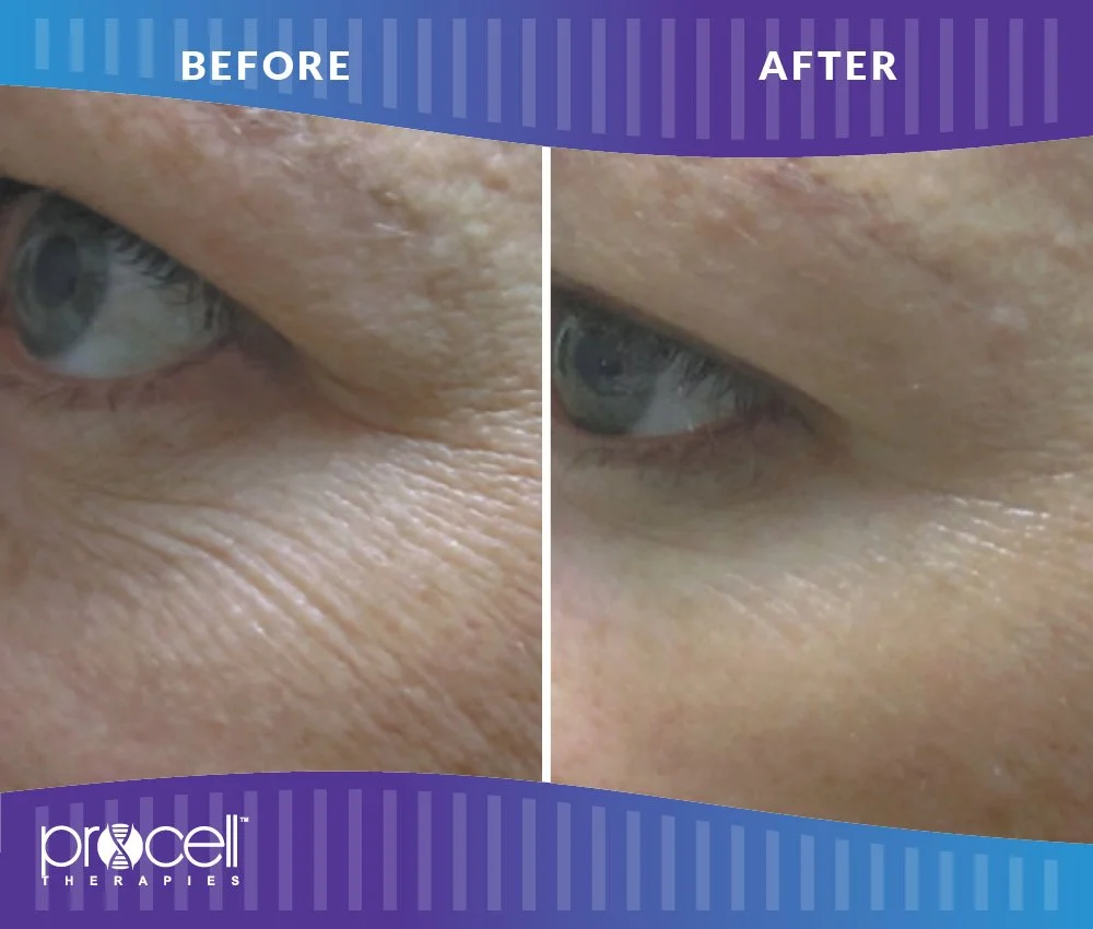 ProCell Before and After Image