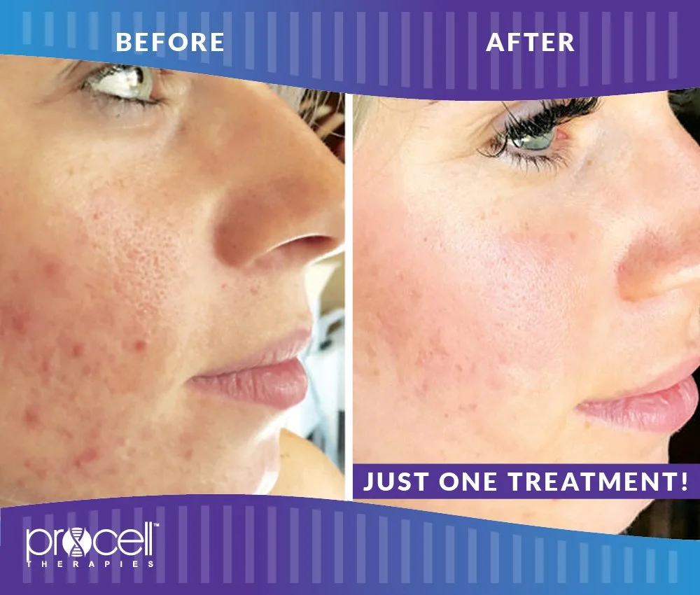 ProCell Before and After Image