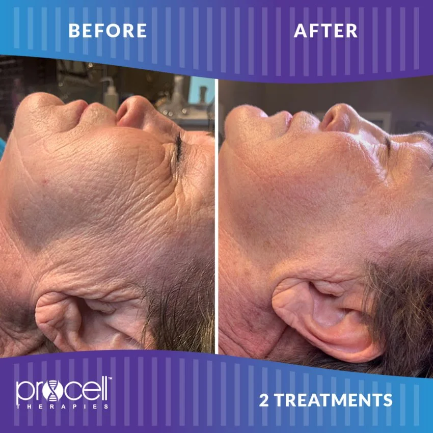 ProCell Before and After Image