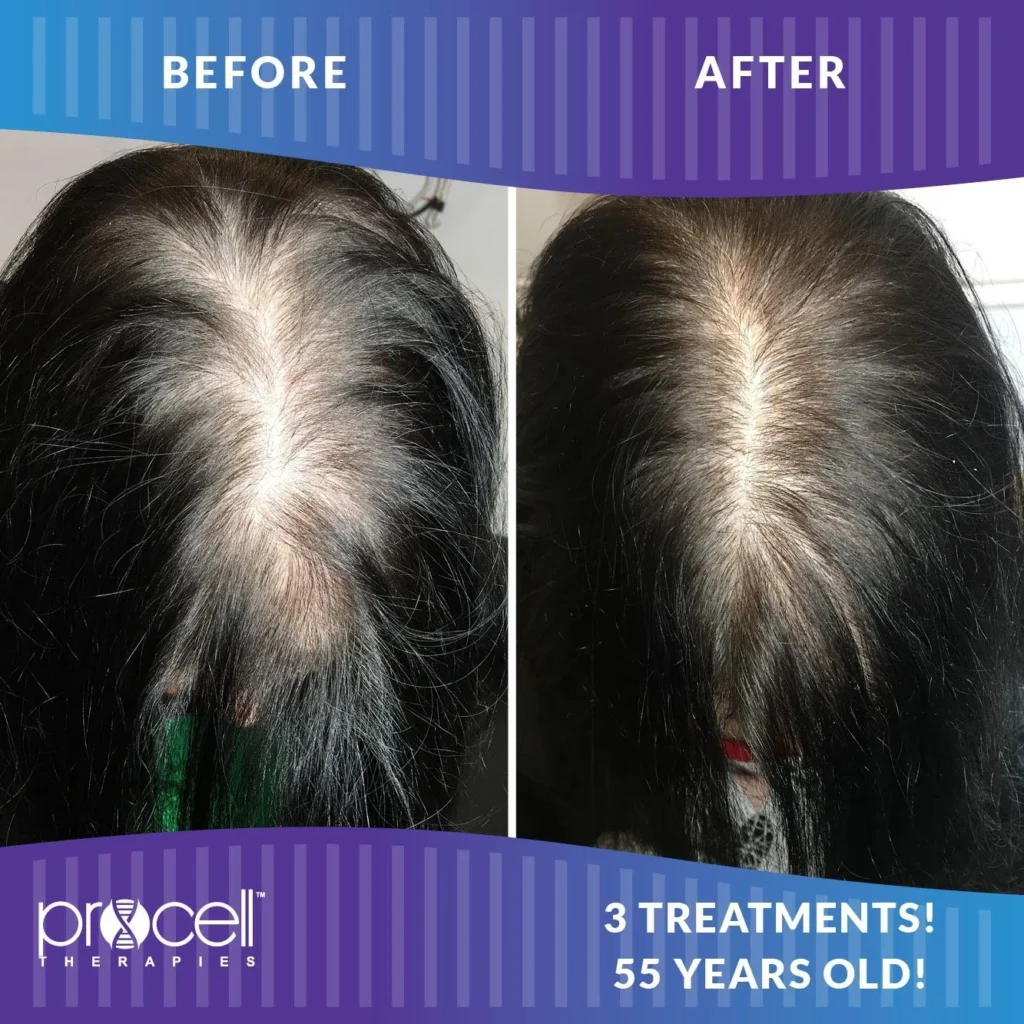 ProCell Before and After Image