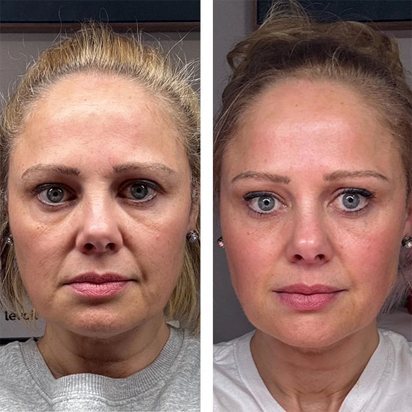 Before and After Image from https://plaxelplasma.com/