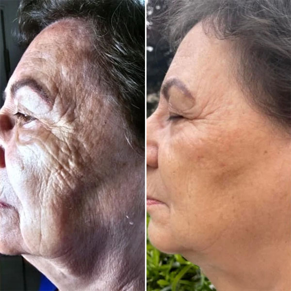 Before and After Image from https://plaxelplasma.com/