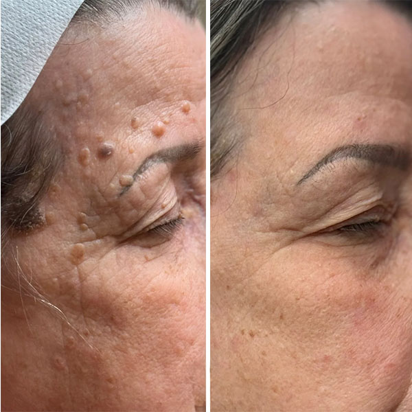 Before and After Image from https://plaxelplasma.com/