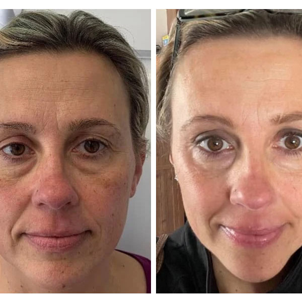 Before and After Image from https://plaxelplasma.com/