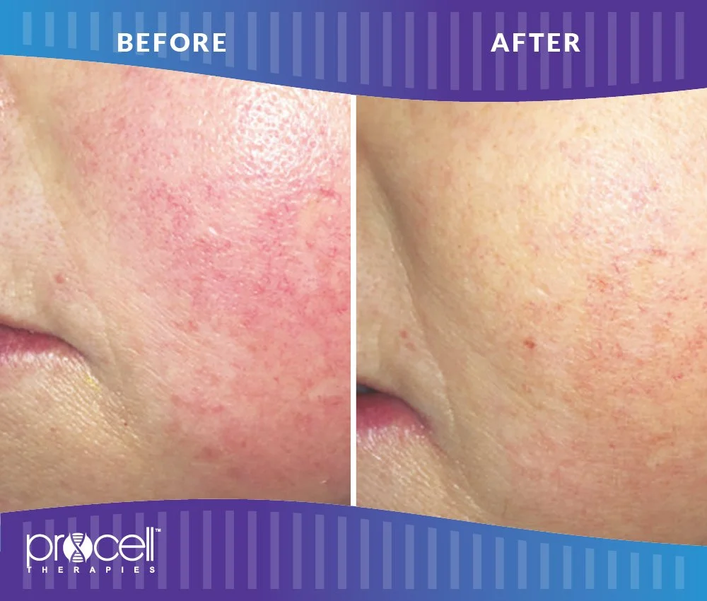 ProCell Before and After Image