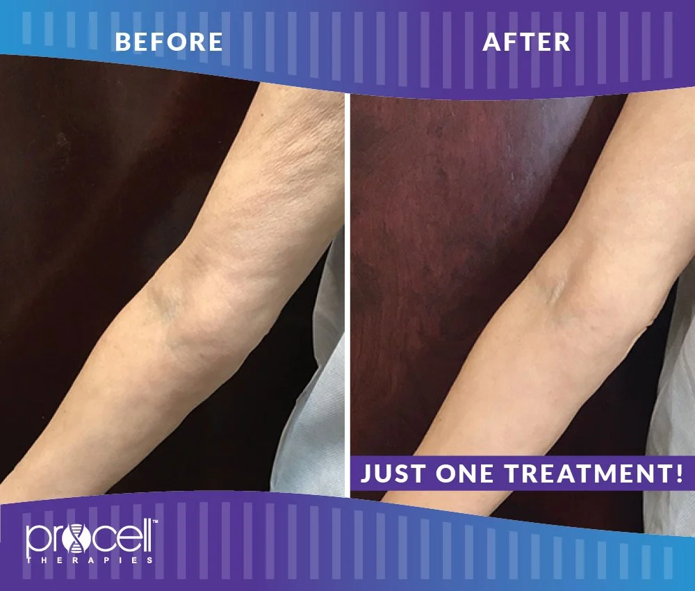 ProCell Before and After Image